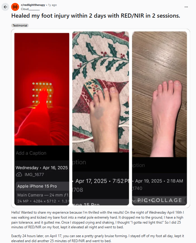 Foot injury healed with red light therapy