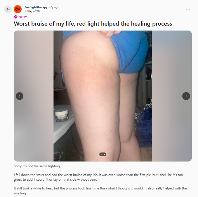 Bruise healing with red light therapy