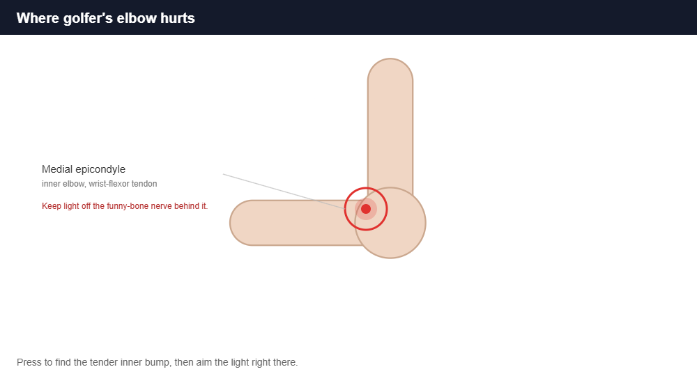Diagram of the medial epicondyle on the inner elbow where golfer elbow pain occurs