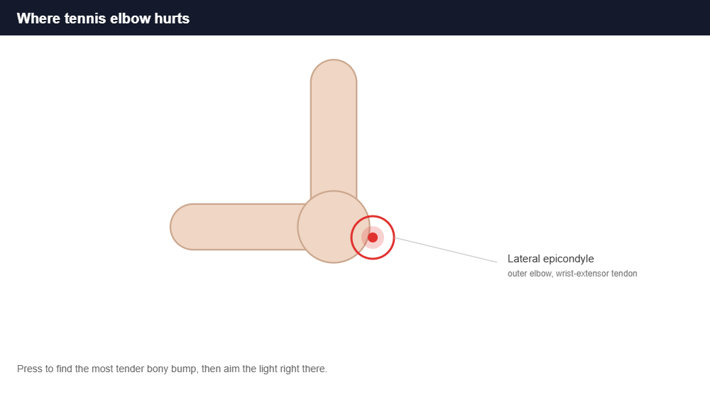 Diagram of the lateral epicondyle on the outer elbow where tennis elbow pain occurs