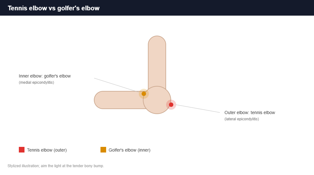 Tennis elbow vs golfer elbow Diagram showing tennis elbow on the outer elbow and golfer elbow on the inner elbow